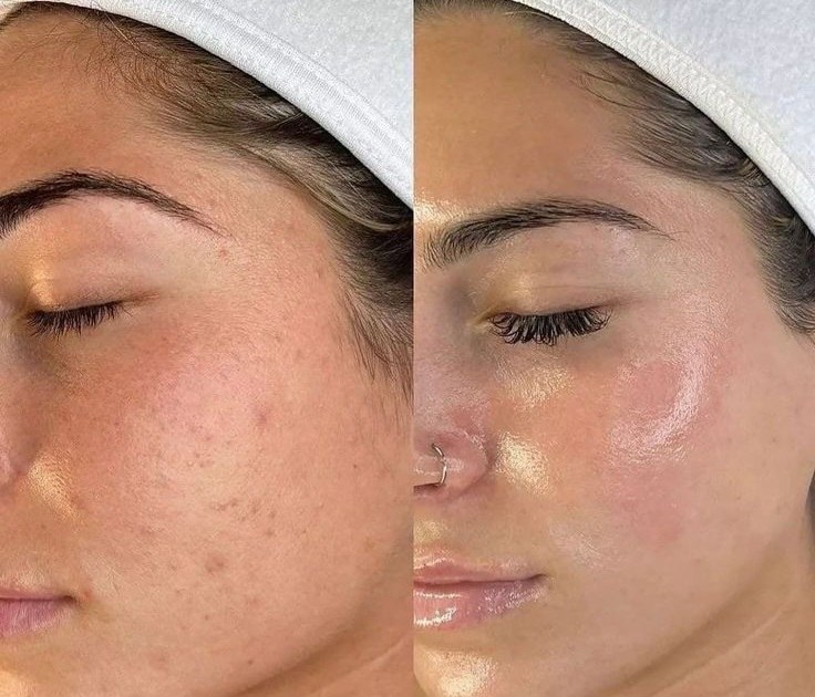 Nettoyage de Peau à Tizi Ouzou - Soin esthétique MEL'GLOW